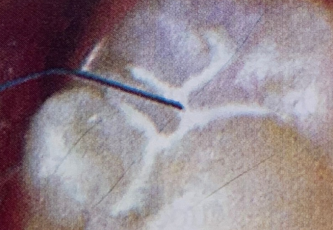 [TƯ VẤN] 3 vật liệu TRÁM BÍT HỐ RÃNH chống sâu răng